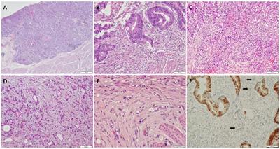 Predicting lymph node metastasis and recurrence in patients with early stage colorectal cancer